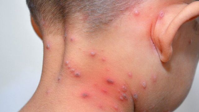 La segunda dosis de la vacuna contra la varicela será obligatoria para niños de cinco años