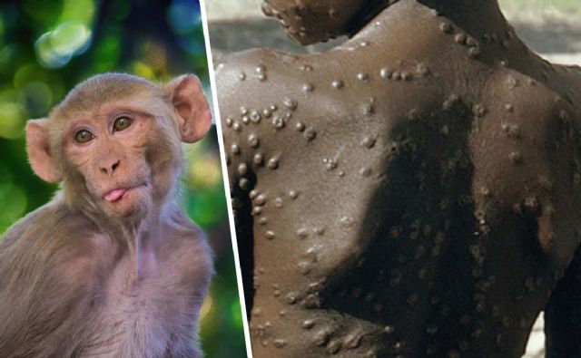 OMS: reunión de emergencia por el aumento de casos de viruela del mono